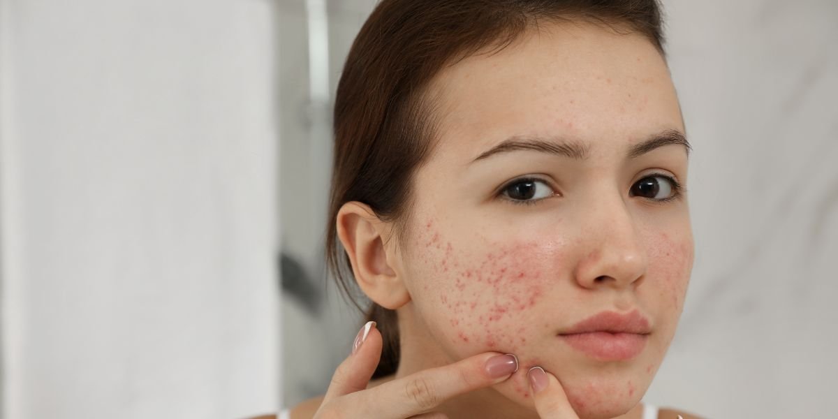 How to Treat Acne Scars and Prevent New Breakouts